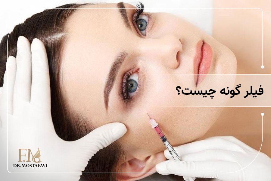 فیلر گونه چیست؟