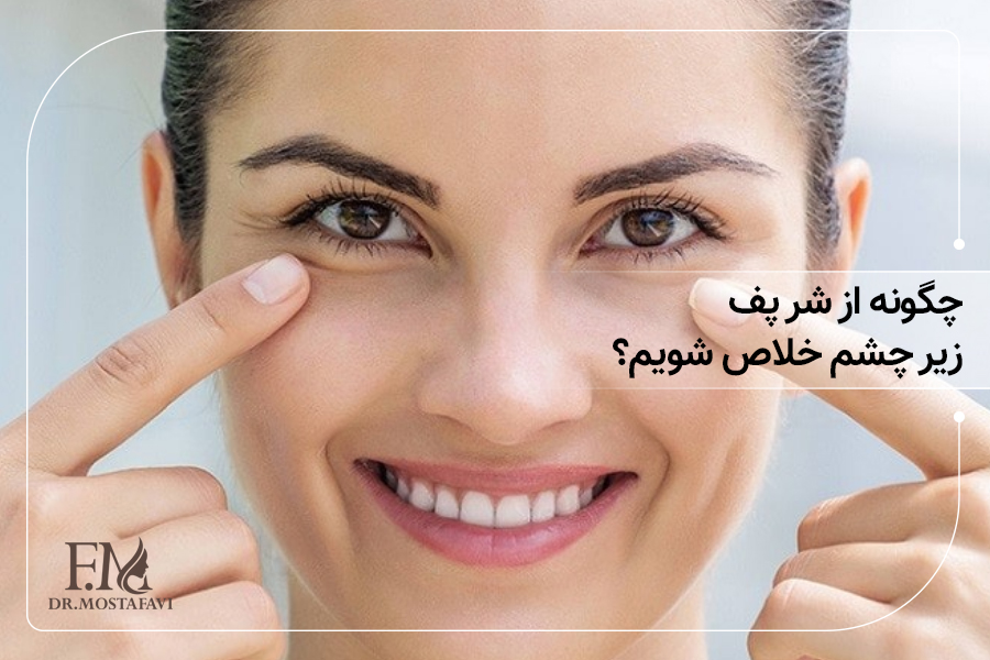 چگونه از شر پف زیر چشم خلاص شویم؟