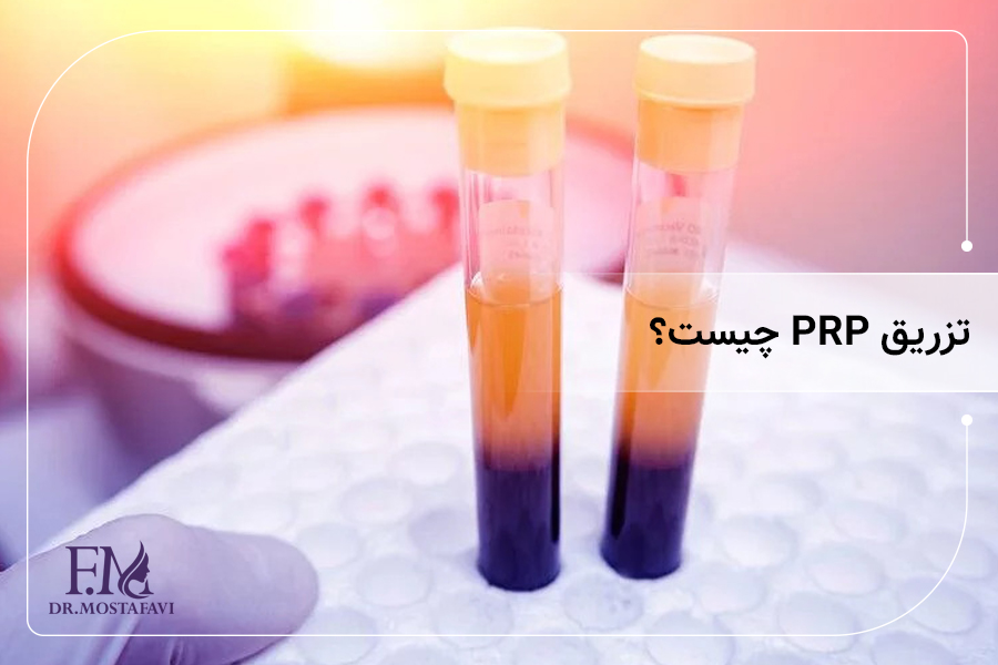 تزریق PRP چیست؟